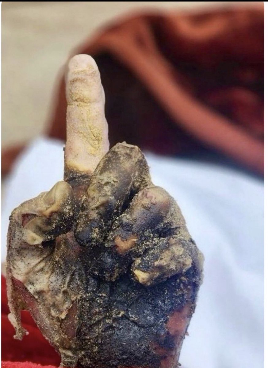 یہ جلا ہو ہاتھ ایک عزہ کے شہید مسلمان بھاٸی کا ھے جو تمام ستاون مردہ ممالک سے کہہ رہا ھے اللہ ایک ھے اس کا کوٸی شریک نہیں وہ ھمارا مدد گار ھے تم اہل یہود کے خوب تلوے چاٹو  خوب دوستیاں کرو مگر ایک یاد رکھو اللہ فرماتا ھے یہود نصاریٰ کبھی دوست نہیں سکتے
#نوائےسحر