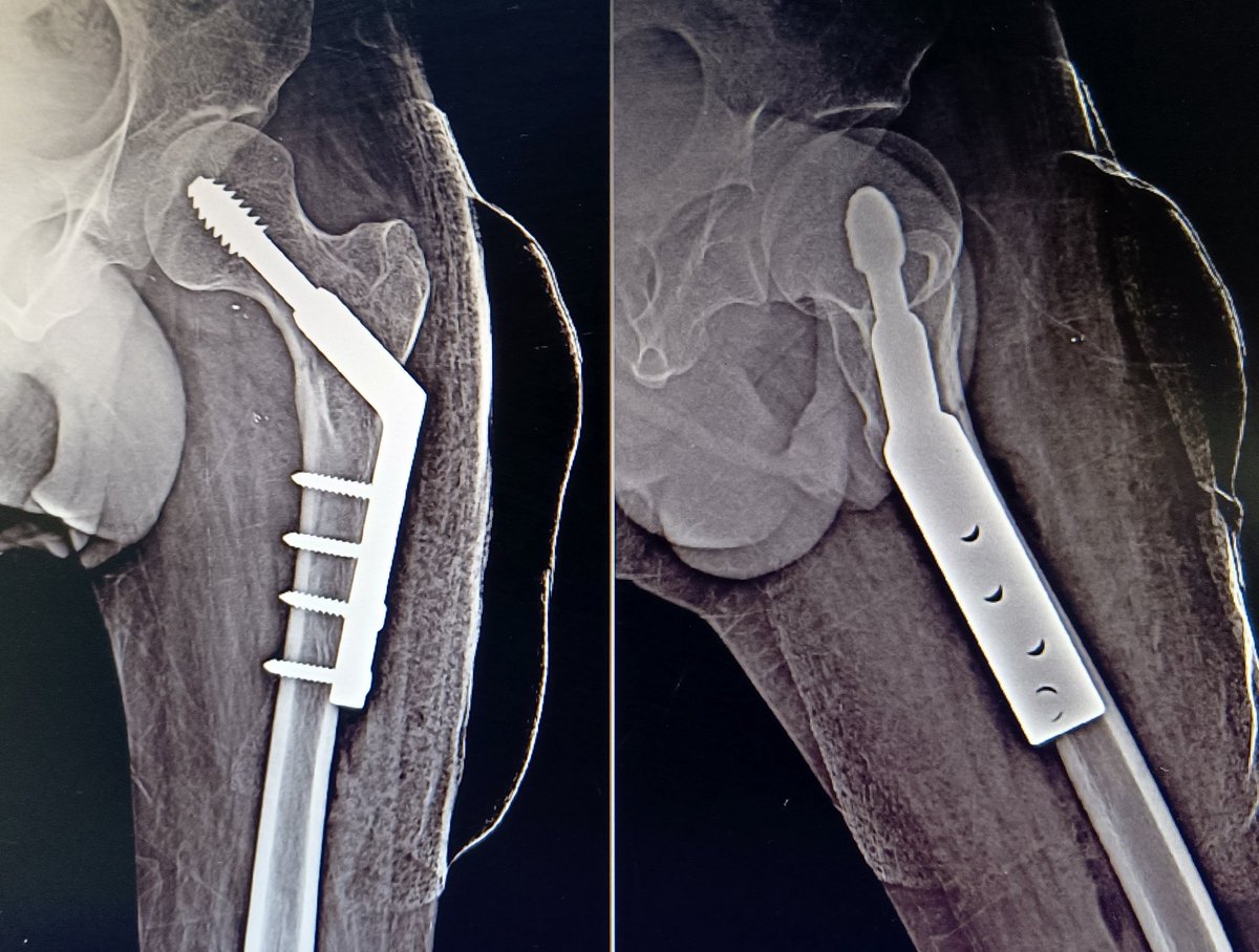 It's important to look carefully for fracture if patient is having severe pain in hip after injury ...

This kind of undisplaced basicervical nof fractures can be easily missed...

Dhs is ideal implant for this kind of fractures (I feel)

#medtwitter #orthotwitter #orthox
