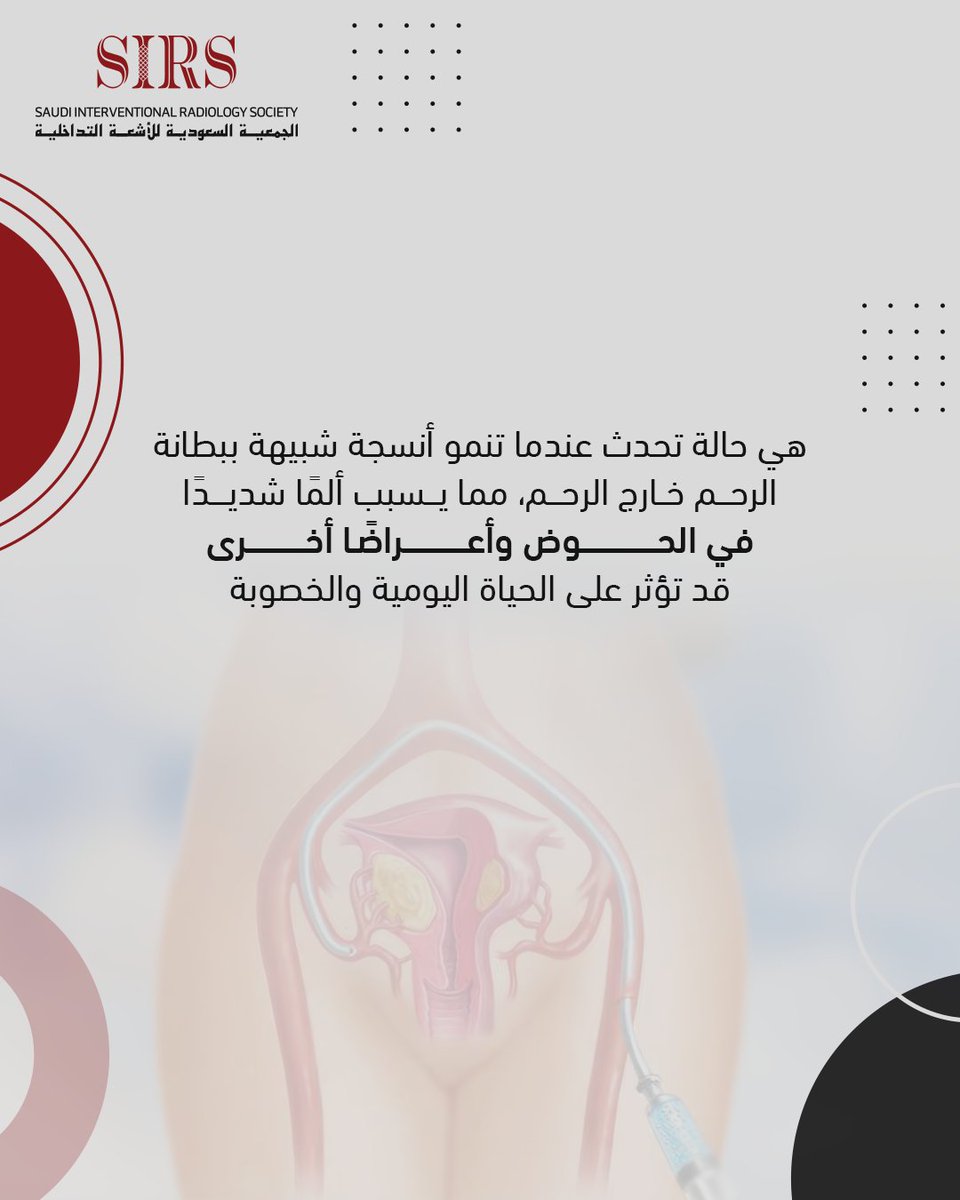 sirs_ksa's tweet photo. ما هي بطانة الرحم المهاجرة؟
⚠️ تعانين من ألم مزمن في الحوض أو آلام شديدة خلال الدورة الشهرية؟ قد تكون بطانة الرحم المهاجرة السبب!
💡 تحدث هذه الحالة عندما تنمو أنسجة شبيهة ببطانة الرحم خارج الرحم، مما يسبب ألمًا حادًا، اضطرابات في الدورة الشهرية، وصعوبة في الحمل.
لا تتجاهلي الأعراض! التشخيص المبكر يساعدكِ في الحصول على العلاج المناسب وتحسين جودة حياتكِ.

#الاشعة_التداخلية #الصحة #معلومة