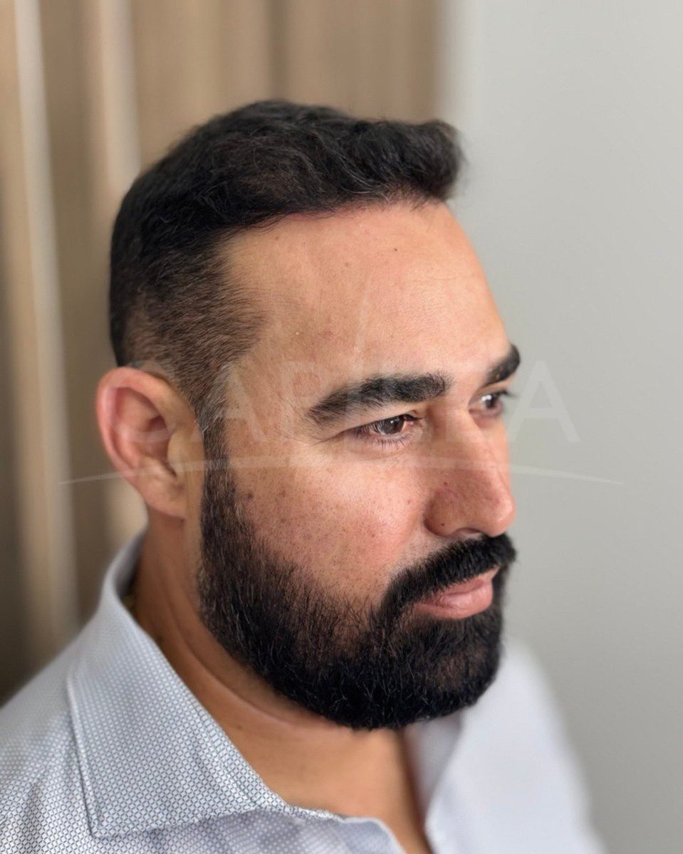 Aviso COFEPRIS 2319012002A00017
#drhectortreviño #capilea #capileamonterrey #hairtrasplant #injertocapilar #microinjertocapilar  #fuetechnique #trasplantecapilar   #capileatijuana #capileacdmx #drhectortrevino #capileamexico #hairtrasplantsurgeon