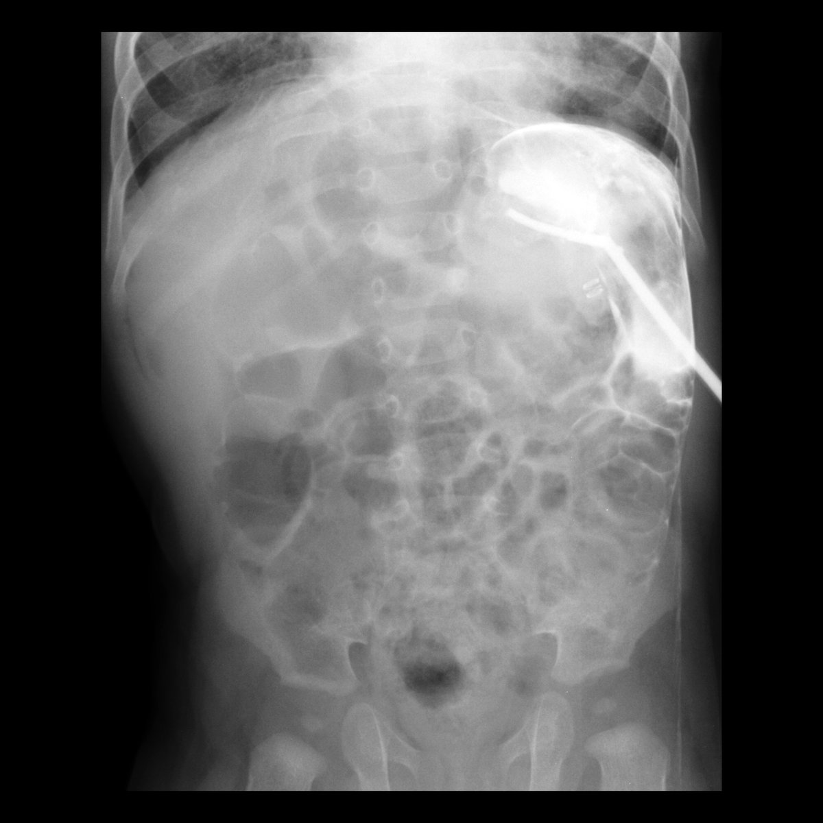 #FOAMed #MedEd #FOAMPed #FOAMRad #PedsRad #RadEd #RadRes #radiology #pediatrics #PedSurgery #PedSurg #SoMe4PedSurg

Toddler after a gastrostomy tube change

AP radiograph of the abdomen after injection of water soluble contrast through the gastrostomy tube shows contrast