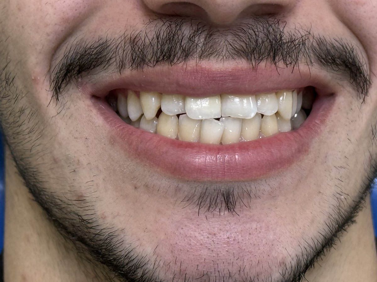 pur226's tweet photo. Single zirconia crown#11 https://t.co/pO6ZIGxHez
