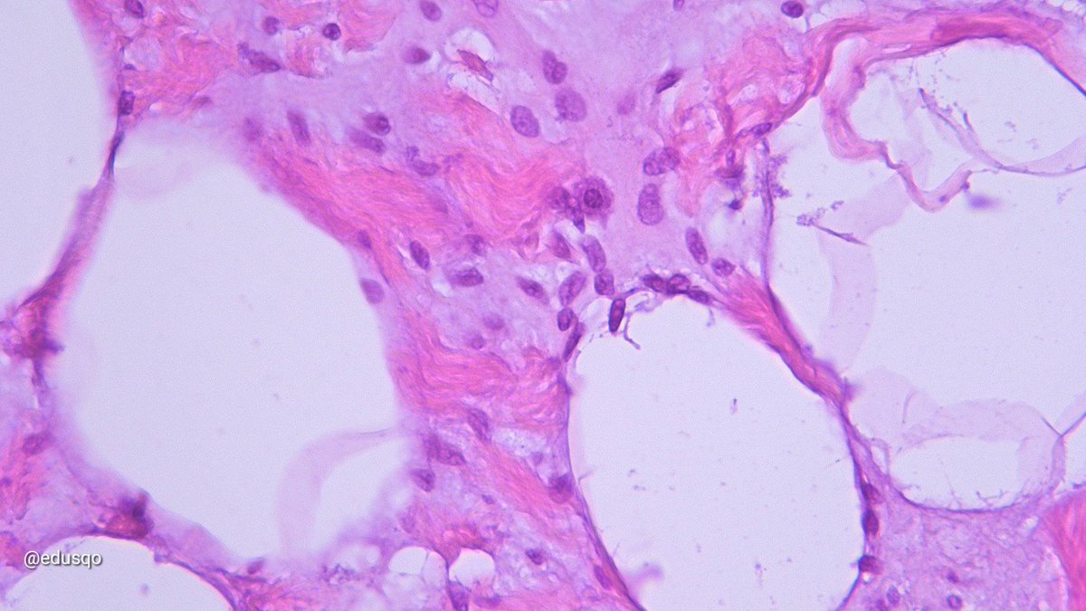 Spindle cell lipoma:
▫️Benign neoplasm
▫️Middle aged to elderly men
▫️80% arise in the subcutaneous tissue of the neck (posterior), back and shoulders
▫️Mature adipocytes + bland spindle cells + rope-like collagen fibers
▫️Myxoid stroma with mast cells
#DermPath #BSTPath