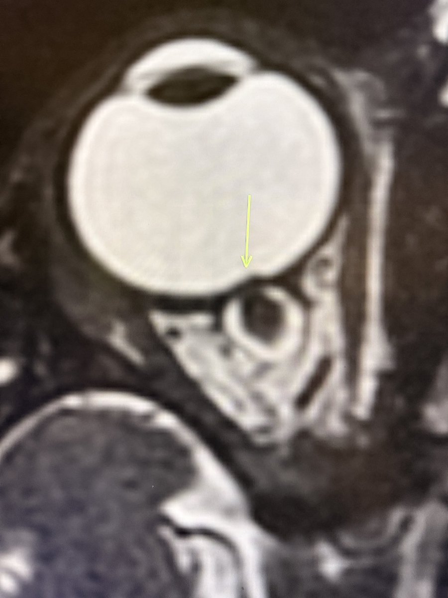 Nothing fancy today!

Just a classic case of papilledema on MRI:

1. Flattened posterior sclera
2. Protrusion of the optic nerve head (bulging into the globe)

—Classic signs from my reporting list