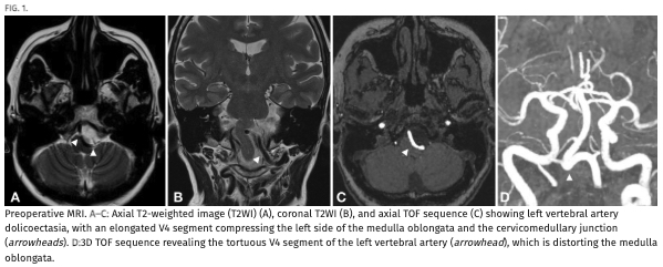 #JNSCaseLessons. Authors highlight novel neurovascular decompression technique for management of intractable hiccups secondary to vertebral artery dolichoectasia. thejns.org/caselessons/vi…