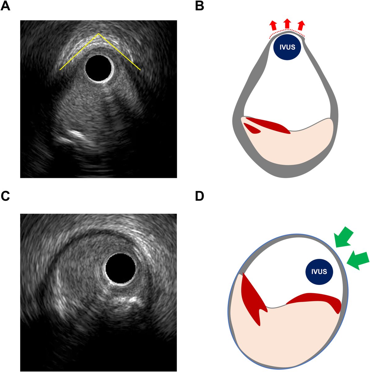 Giuseppe Biondi-Zoccai (@gbiondizoccai) on Twitter photo Want to avoid rotablation-induced coronary perforation? Then avoid segments where IVUS shows a Tenting Sign onlinelibrary.wiley.com/doi/full/10.10… <a href="/ccijournal/">CCIjournal</a> Want to avoid rotablation-induced coronary perforation? Then avoid segments where IVUS shows a Tenting Sign onlinelibrary.wiley.com/doi/full/10.10… <a href="/ccijournal/">CCIjournal</a>