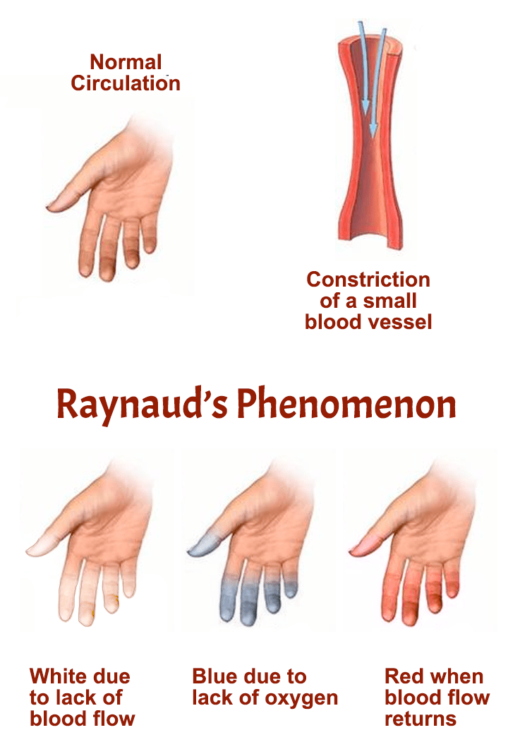 Educational image placeholder: numbness tingling and pain in fingers affected by Raynaud's