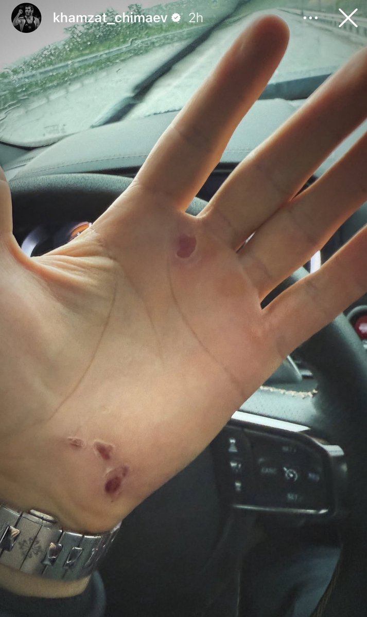 Home of Fight (@home_of_fight) on Twitter photo 😳😬 Khamzat Chimaev posts a photo of his hand full of blisters on Instagram
(via. <a href="/KChimaev/">Khamzat Chimaev</a>)▫️ 😳😬 Khamzat Chimaev posts a photo of his hand full of blisters on Instagram
(via. <a href="/KChimaev/">Khamzat Chimaev</a>)▫️