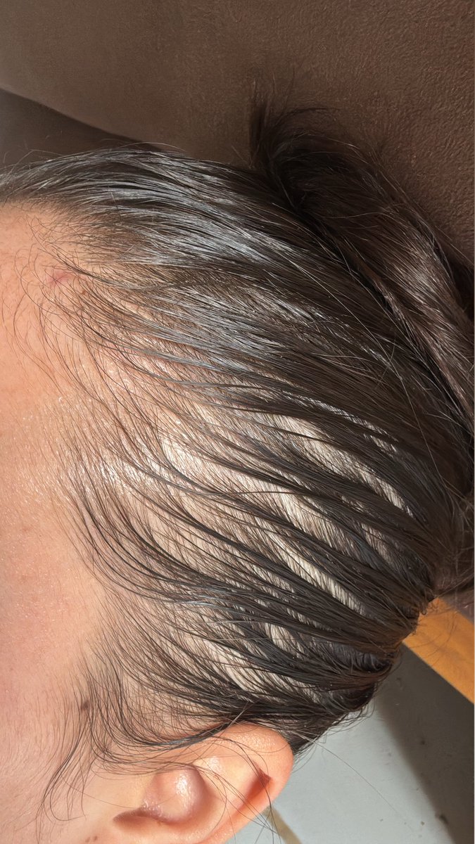 Psiquiatra: Sua queda de cabelo é por causa de estresse, pare de se estressar.

Eu depois de assistir 10 rodadas do Sport no Brasileirão: