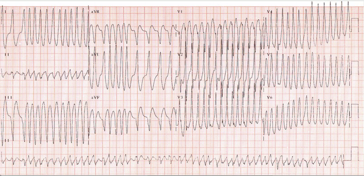 #ECG sent to me with no context.
What's the rhythm? What's the diagnosis