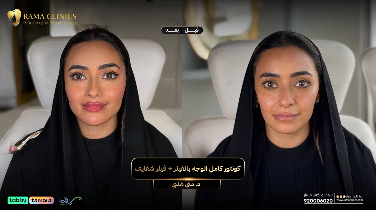 ramaclinics's tweet photo. حالة كونتور كامل الوجه بالفيلر+فيلر شفايف مع د.منى شلبي 💕
الحين راح تستفيدي بكاش باك 10% راجعين لك لما تشتري عروضنا من تطبيق راما أونلاين🌟💗
#كاش_باك #كونتور #تجميل #عيادات_تجميل #فيلر #فيلر_الوجه #تكساس #تحديد_فك #عالمك_الخاص #عروض #rama_clinics https://t.co/bxbw3jp4g3