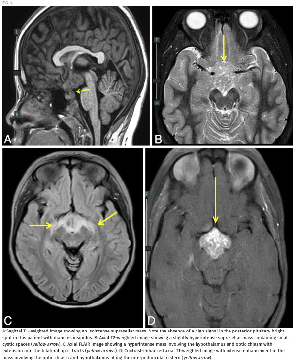 #JNSCaseLessons. Authors highlight rare case of pediatric suprasellar germinoma with semblance to hypothalamic-optic glioma on presentation. thejns.org/caselessons/vi…