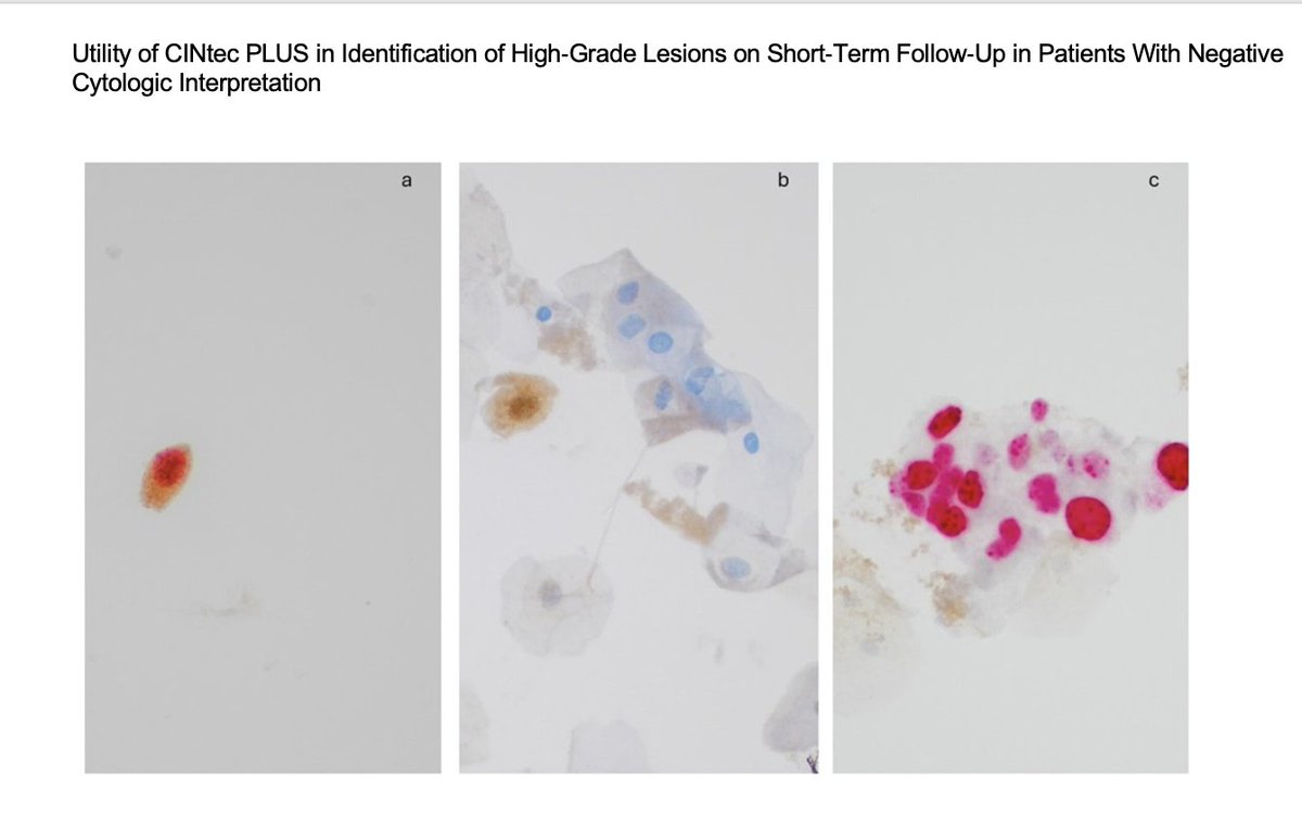 Diagnostic Cytopath (@diagnosticcyto) on Twitter photo New article alert on <a href="/DiagnosticCyto/">Diagnostic Cytopath</a> ! "Utility of CINtec PLUS in Identification of HSIL on Short-Term Follow-Up in Patients With NILM". onlinelibrary.wiley.com/doi/10.1002/dc…
<a href="/PapSociety/">Papanicolaou Society</a> <a href="/IACytology/">International Academy Cytology</a> <a href="/AzizaNassar2/">Aziza Nassar</a> <a href="/aakasharmand/">Zubair Baloch</a> <a href="/PoonamVohra3/">Poonam Vohra MD</a> <a href="/Baskotacytopath/">Swikrity U Baskota,MD, FCAP</a> <a href="/DianaEstherossi/">Esther Diana Rossi</a> @shwetagarwal New article alert on <a href="/DiagnosticCyto/">Diagnostic Cytopath</a> ! "Utility of CINtec PLUS in Identification of HSIL on Short-Term Follow-Up in Patients With NILM". onlinelibrary.wiley.com/doi/10.1002/dc…
<a href="/PapSociety/">Papanicolaou Society</a> <a href="/IACytology/">International Academy Cytology</a> <a href="/AzizaNassar2/">Aziza Nassar</a> <a href="/aakasharmand/">Zubair Baloch</a> <a href="/PoonamVohra3/">Poonam Vohra MD</a> <a href="/Baskotacytopath/">Swikrity U Baskota,MD, FCAP</a> <a href="/DianaEstherossi/">Esther Diana Rossi</a> @shwetagarwal