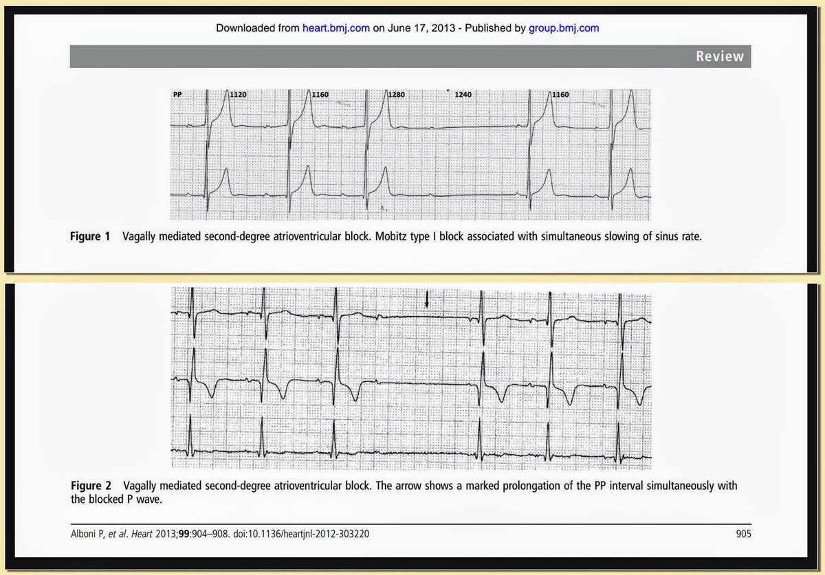 Vagally mediated atrioventricular block: pathophysiology and diagnosis
Paolo Alboni, Anna Holz, Michele Brignole
ECG examples of vagally induced AV block from the fulltext.
pubmed.ncbi.nlm.nih.gov/23286970/