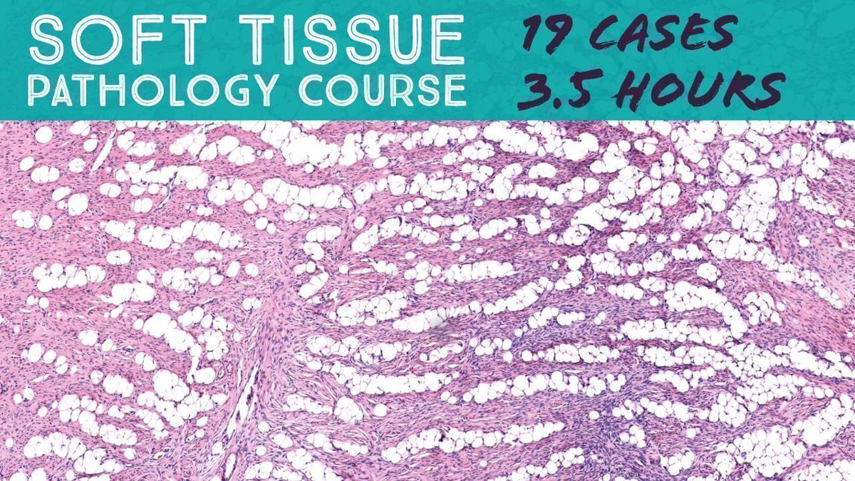 Free Soft Tissue Pathology Course - 19 Cases in 3.5 Hours. Video: youtu.be/MA7YUQ-wnHw?si… (for the Oregon #Pathologists Association 2021 annual meeting). #BSTpath #pathology #pathTwitter #dermpath