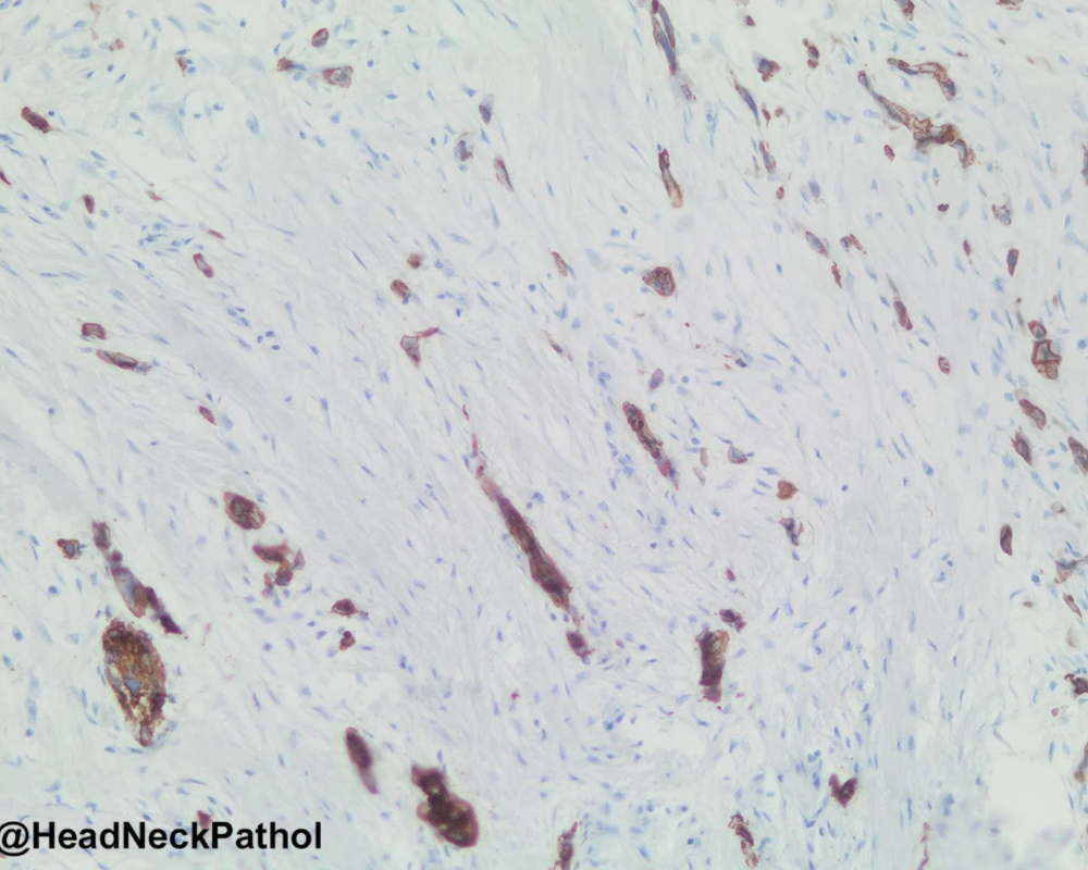 Sclerosing Odontogenic Carcinoma: A Unique Odontogenic Carcinoma with Metastatic Potential
T Malherbe, A Odendaal, J Hille, L J van Rensburg, M Meyer, E Myburgh &amp; A H Afrogheh
rdcu.be/eowvb
#HeadNeckPathol #HNPJ #HeadandNeckPath #Pathology #ENTPath #PathologyTweet