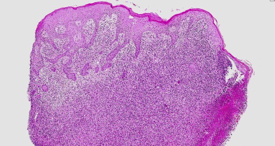 EBV-positive diffuse large B Cell #lymphoma associated to immunosuppression, CD30+, with skin and central nervous system infiltration presented  by Luis Ortega Martínez &amp; Carmen Bellas, Carmen Castellanos and myself in last week #OnHePreS session