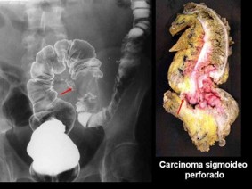 gastroudla's tweet photo. La mayoría de los carcinomas del intestino grueso aparecen el recto y el colon sigmoides, rodean la luz del colon produciendo un canal irregular a través de él #imagengastro https://t.co/jpna8r1QdA