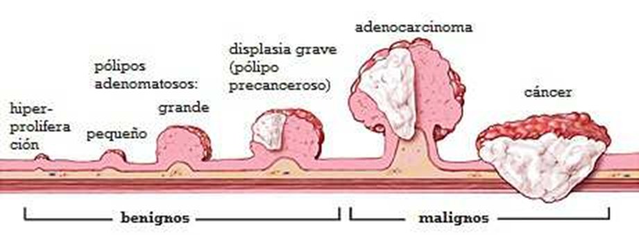 gastroudla's tweet photo. Si el enema opaco sugiere un pólipo, se recomienda una colonoscopía
🛑¡Nunca se debe dejar sin seguimiento!
RECUERDA: Algunos pólipos avanzan lentamente hacia el cáncer de colon. https://t.co/aWtzunon3h