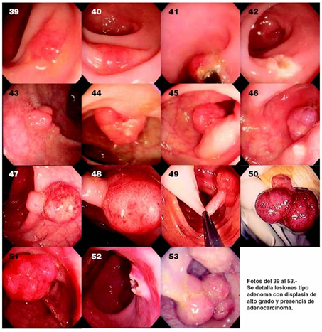 gastroudla's tweet photo. Hallazgos que pueden sugerir malignidad:
· Defecto de llenado irregular o con bordes espiculados.
· Pérdida de distensibilidad del colon en ese segmento.
· Imagen “mordedura de manzana” si hay una masa maligna.
· Pólipos grandes (>2 cm), múltiples o con forma irregular. https://t.co/R4SC4WcH17