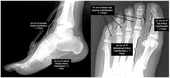Understanding the Prevalence of Medial Arterial Calcification Among Complex Reconstructive Patients: Insights from a Decade of Experience at a Tertiary Limb Salvage Center mdpi.com/2077-0383/14/2…