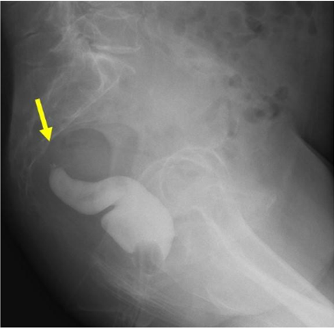 gastroudla's tweet photo. Enema Opaco Post-Qx tardío de intervención Hartmann: se ve muñón rectal calibre normal de la ampolla hasta las grapas quirúrgicas que termina en saco ciego sin fuga de contraste S:80% - E:100%. #imagengastro https://t.co/2FdSHnwRsH