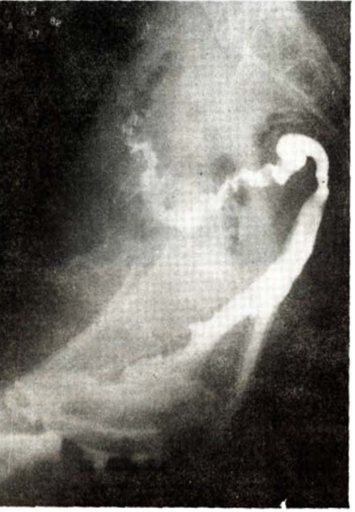 gastroudla's tweet photo. 👉Enema opaco Preoperatorio: Fístula Recto Vaginal (fina columna de contraste en comunicación anómala) S: 70% - E:100%
👉Enema opaco control: sin fístula recto vaginal (opacificación adecuada del recto y colon distal) #imagengastro https://t.co/OHxAPKpHTX