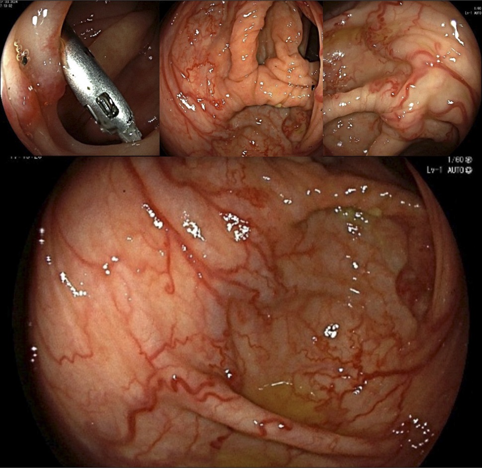 ACGCRJ (@acgcrj) on Twitter photo 🗣️Image Challenge⏰#ACGCRJ
👉What are colonoscopy findings🔍
👉How would you manage it🎯💉
📚bit.ly/3HlqURc
<a href="/UMKCmedschool/">UMKC School of Medicine</a> <a href="/NadeemYousafMD/">Nadeem Yousaf</a> <a href="/PrateekHarne1/">Prateek Harne MBBS, MD</a> <a href="/AmCollegeGastro/">ACG</a> #GITwitter #MedTwitter
<a href="/ACG_EBGI/">Evidence-Based GI: An ACG Publication (EBGI)</a> <a href="/AmJGastro/">AJG - The American Journal of Gastroenterology</a> <a href="/ACG_CTG/">ACG_CTG</a> <a href="/umer446/">Umer Farooq</a>
<a href="/TelbanyMD/">Ahmed Telbany MD, MPH</a> #endoscopy <a href="/LiverFellow/">Liver Fellow Network</a> 🗣️Image Challenge⏰#ACGCRJ
👉What are colonoscopy findings🔍
👉How would you manage it🎯💉
📚bit.ly/3HlqURc
<a href="/UMKCmedschool/">UMKC School of Medicine</a> <a href="/NadeemYousafMD/">Nadeem Yousaf</a> <a href="/PrateekHarne1/">Prateek Harne MBBS, MD</a> <a href="/AmCollegeGastro/">ACG</a> #GITwitter #MedTwitter
<a href="/ACG_EBGI/">Evidence-Based GI: An ACG Publication (EBGI)</a> <a href="/AmJGastro/">AJG - The American Journal of Gastroenterology</a> <a href="/ACG_CTG/">ACG_CTG</a> <a href="/umer446/">Umer Farooq</a>
<a href="/TelbanyMD/">Ahmed Telbany MD, MPH</a> #endoscopy <a href="/LiverFellow/">Liver Fellow Network</a>