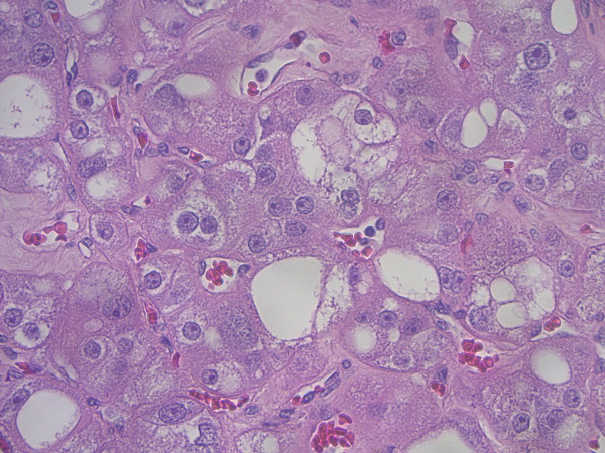 Kidney; Eosinophilic vacuolated tumor (EVT): Other oncocytic tumor (WHO 5th). Solid growth of eosinophilic cells with cytoplasmic vacuolation and prominent nucleoli with large vessels at periphery. CD117+Cathepsin+CK7-
TSC1,TSC2 or MTOR mutations #GUPath #PathX #PathTwitter