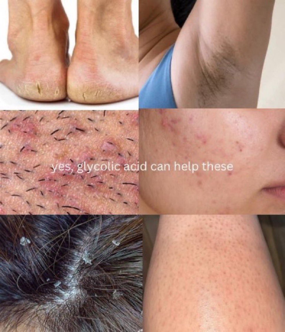 _zhraxs's tweet photo. Berabad pakai brightening deodorant takde kesan pun kan?

&amp; some even struggle with body odor even dah shower &amp; guna deodorant

CHEAP TIPS: guna glycolic acid, within a week dah nampak underarm makin cerah! Tapi tak boleh main pakai je ye.

➤ ways &amp; precautions to use GA: https://t.co/pvVbZikeb4