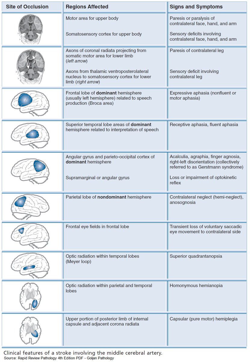 ManualOMedicine's tweet image. Clinical Features of a Stroke Involving the Middle Cerebral Artery (MCA)

#medtwitter #foamed #usmle