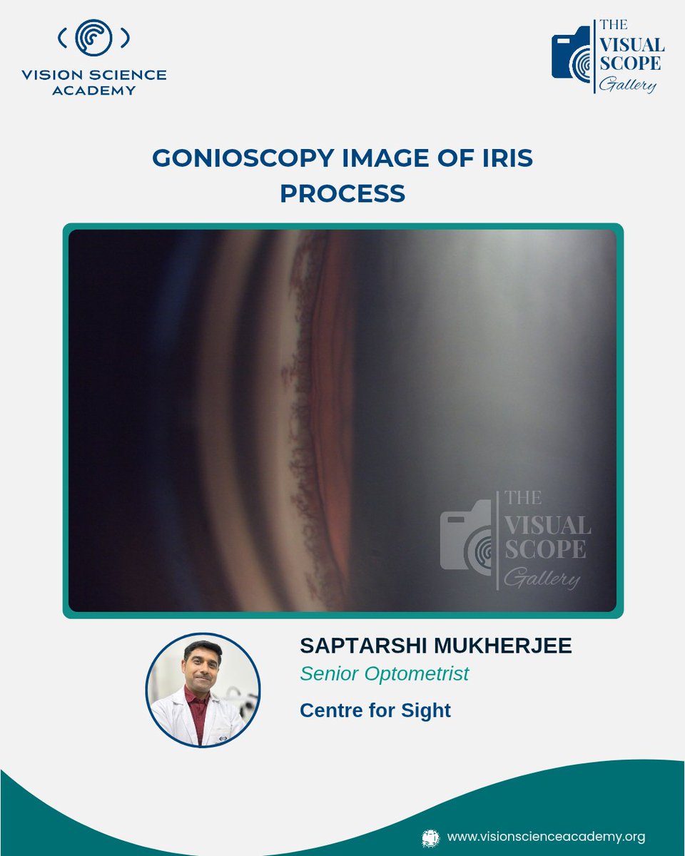 science_vision's tweet image. Gonioscopy Image of The Iris Processes

Image Author: Saptarshi Mukherjee
Senior Optometrist
Centre for Sight

View the photography here: visionscienceacademy.org/gonioscopy-ima…

#IrisProcess #Gonioscopy #AnteriorSegment #AngleRecession #OcularTrauma #OptometryEducation #VisionScience