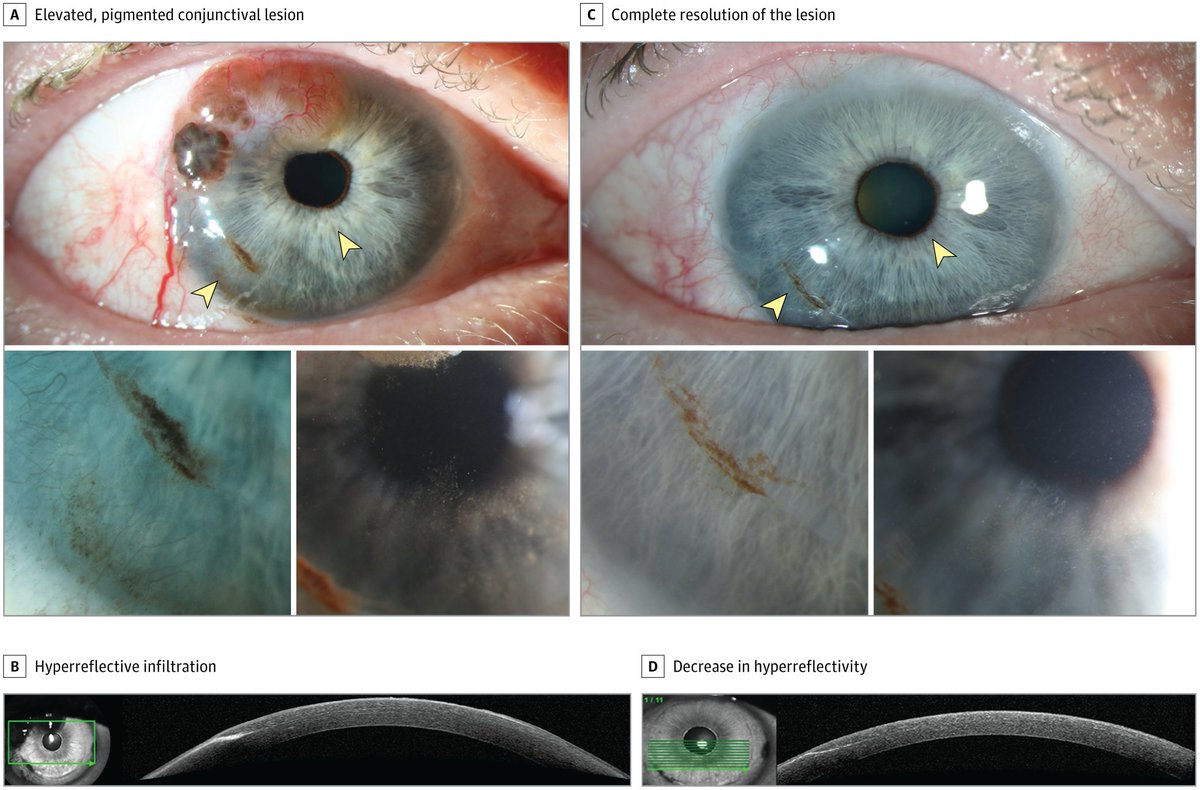 JAMA Ophthalmology (@jamaophth) on Twitter photo This case report describes invasion of a laser-assisted in situ keratomileusis (LASIK) flap interface by conjunctival malignant melanoma in a male patient aged 71 years. ja.ma/4krm1Vq <a href="/LADalvinMD/">Lauren A. Dalvin, MD</a> This case report describes invasion of a laser-assisted in situ keratomileusis (LASIK) flap interface by conjunctival malignant melanoma in a male patient aged 71 years. ja.ma/4krm1Vq <a href="/LADalvinMD/">Lauren A. Dalvin, MD</a>