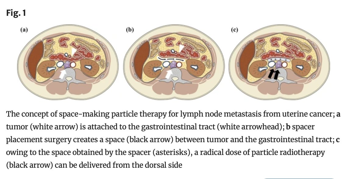 Annals of Surgical Oncology (@annsurgoncol) on Twitter photo June Issue: Combination Treatment with Spacer Placement Surgery Followed by Particle #Radiotherapy for Lymph Node Metastasis from #UterineCancer
rdcu.be/epMxc
<a href="/esragbilir/">Esra Bilir, MD, MSc</a>
<a href="/SyedAAhmad5/">Syed A. Ahmad</a> June Issue: Combination Treatment with Spacer Placement Surgery Followed by Particle #Radiotherapy for Lymph Node Metastasis from #UterineCancer
rdcu.be/epMxc
<a href="/esragbilir/">Esra Bilir, MD, MSc</a>
<a href="/SyedAAhmad5/">Syed A. Ahmad</a>
