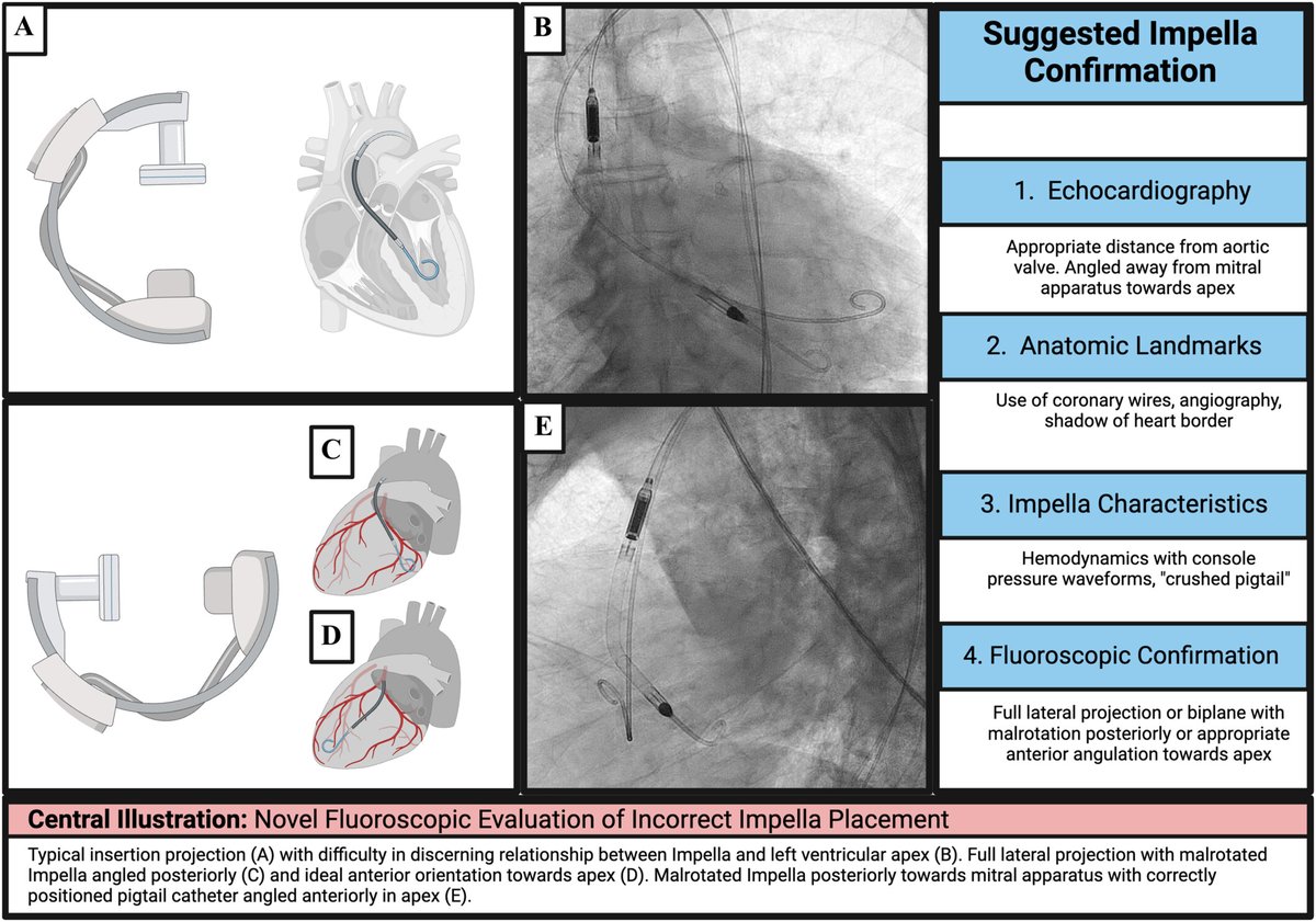 Giuseppe Biondi-Zoccai (@gbiondizoccai) on Twitter photo Novel Fluoroscopic Evaluation of Incorrect #Impella Placement, courtesy of Andrew P. Hill et al onlinelibrary.wiley.com/doi/full/10.10… <a href="/ccijournal/">CCIjournal</a> Novel Fluoroscopic Evaluation of Incorrect #Impella Placement, courtesy of Andrew P. Hill et al onlinelibrary.wiley.com/doi/full/10.10… <a href="/ccijournal/">CCIjournal</a>