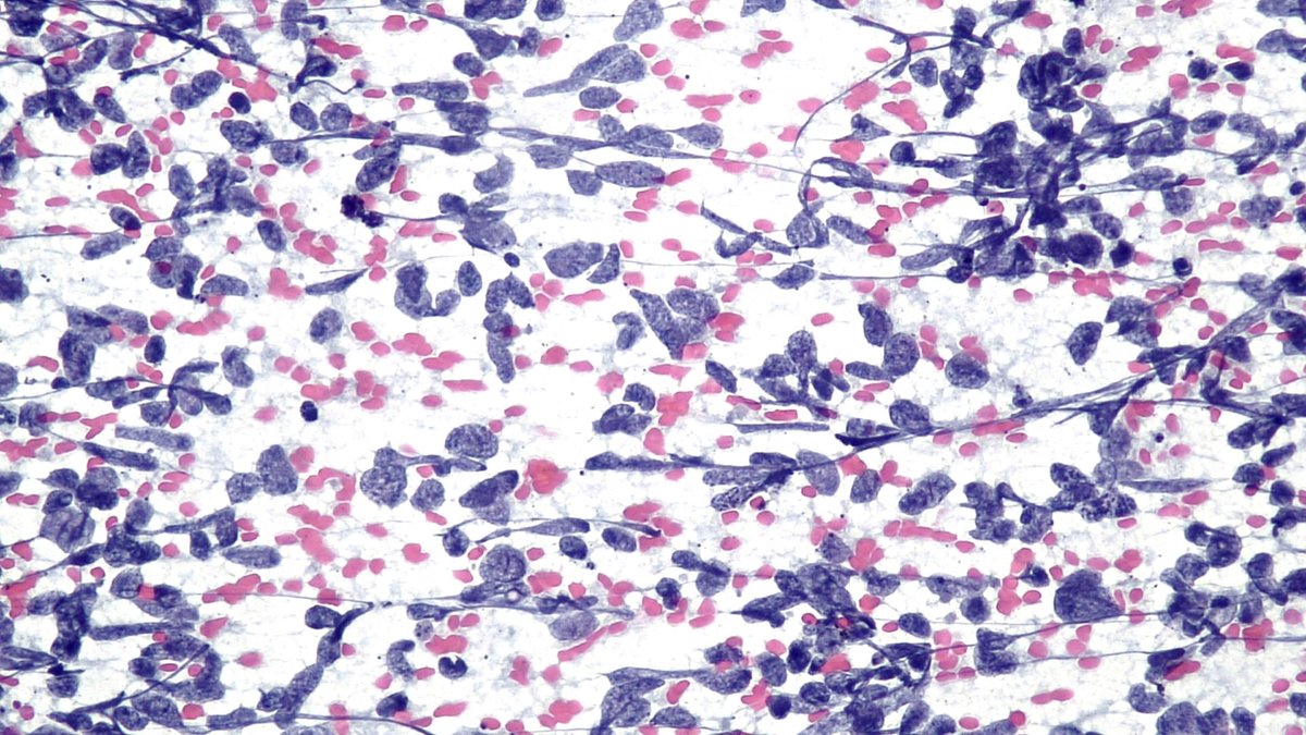 Key diagnostic cytological features of lung small cell carcinoma:
-Chromatine: fine &amp; dark 
- Nucleoli: absent or inconspicuous
-Cytoplasm: scant 
Bonuns: nuclear molding, crush artifact, apoptotic cells, blue bodies, necrosis, 🔬💯🫁 👇