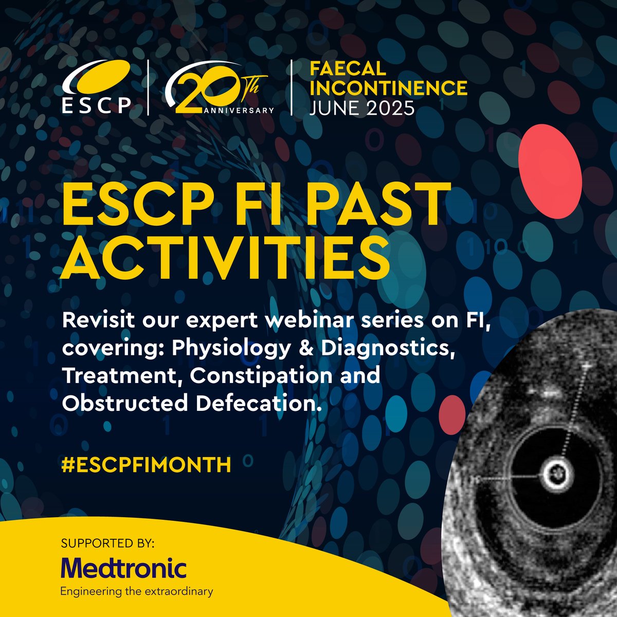 escp_tweets's tweet photo. 🟡 As part of #ESCPFIMonth, we’re spotlighting a key ESCP resource — the Faecal Incontinence & Obstructed Defecation Webinar Series

📚 Topics include:
✅ Physiology & Diagnostics
✅ Faecal Incontinence (Parts 1 & 2)
✅ Constipation & Obstructed Defecation
🎥 Watch on demand: https://t.co/afLTKCnNmn

#FaecalIncontinence #ColorectalSurgery #PelvicFloor #ESCP