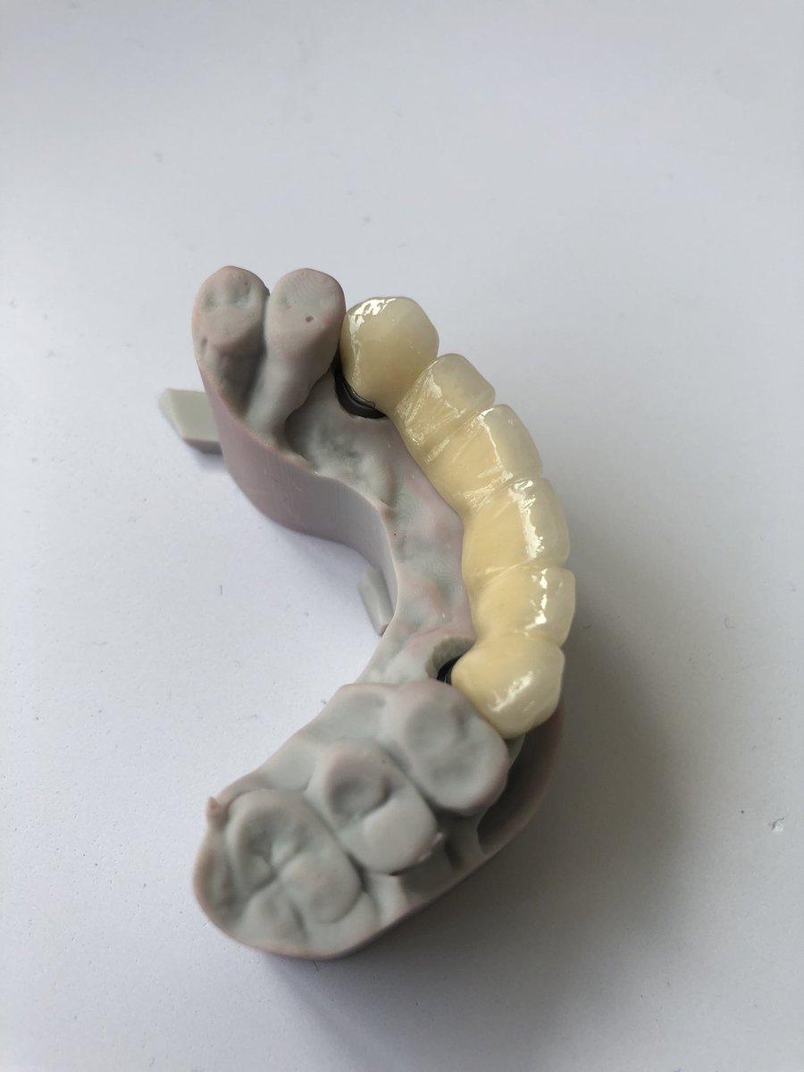SZDiamonddental's tweet image. PFM Bridge
#3DPrinting #dentallab #fixedteeth #pfm #dental