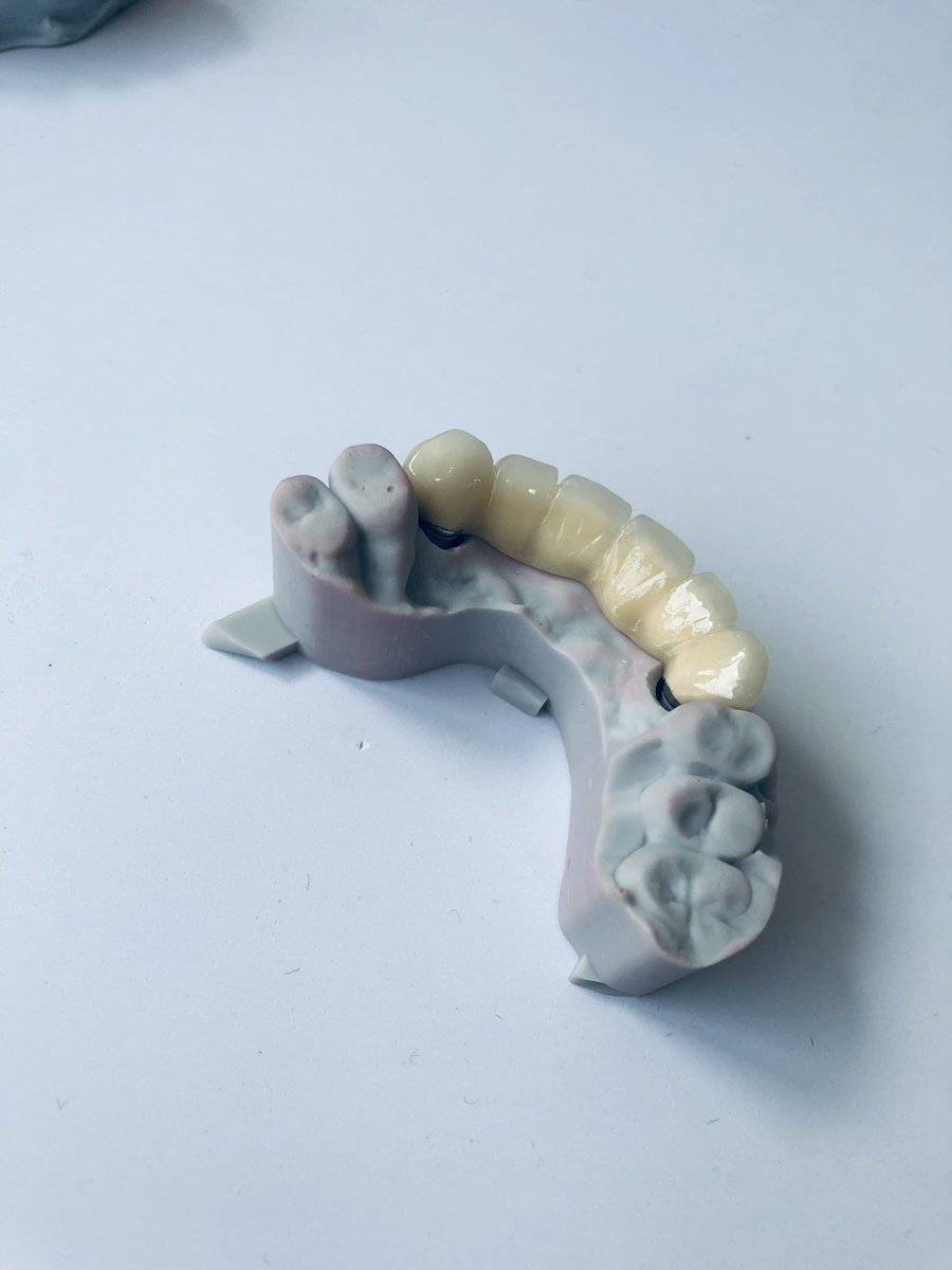 SZDiamonddental's tweet image. PFM Bridge
#3DPrinting #dentallab #fixedteeth #pfm #dental