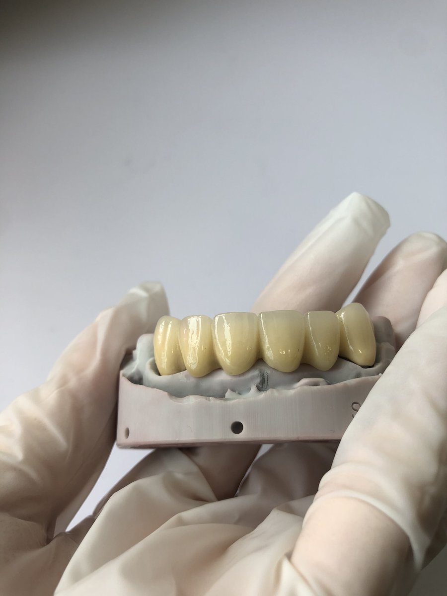 SZDiamonddental's tweet image. PFM Bridge
#3DPrinting #dentallab #fixedteeth #pfm #dental