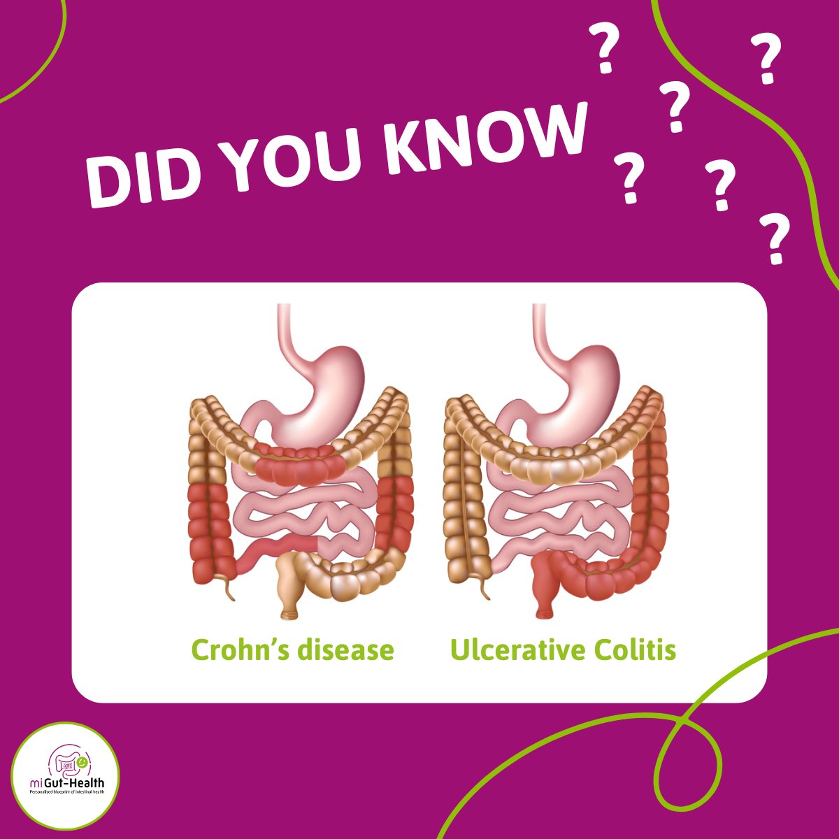 #IBD includes Crohn’s disease  &amp; ulcerative colitis — but they affect the body differently:
🔸 Crohn’s: Anywhere   in the digestive tract
 🔸 UC:   Colon &amp; rectum only
Awareness starts with understanding. 💜
migut-health.eu/about-ibd/trea…

#DidYouKnow #CrohnsDisease #UlcerativeColitis