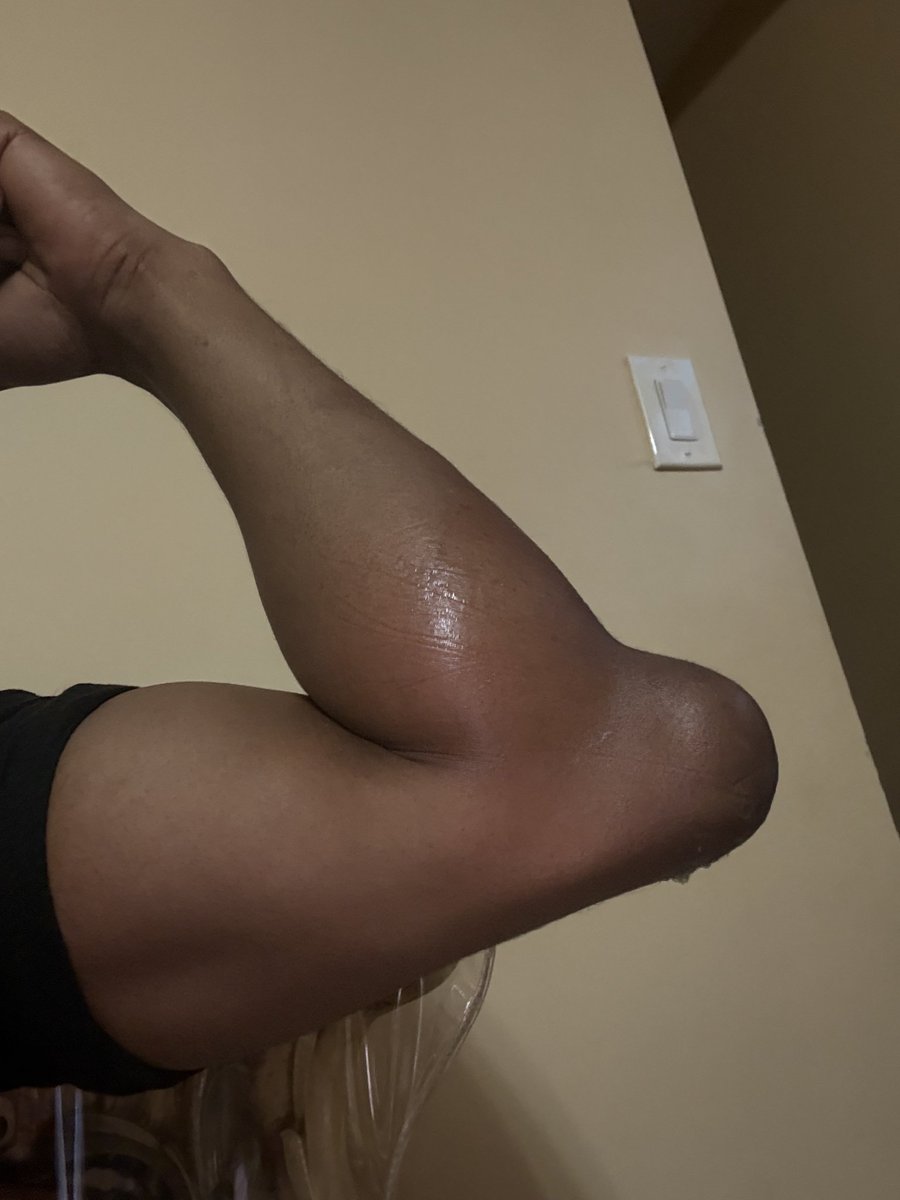 Буквално вака имав изместено и скршено рака. Само кај мене мускулите и тетивите сама ја повлекоа назад на "место", и не остана долго во оваа позиција. А болката се појави 72 часа подоцна. Ауч!