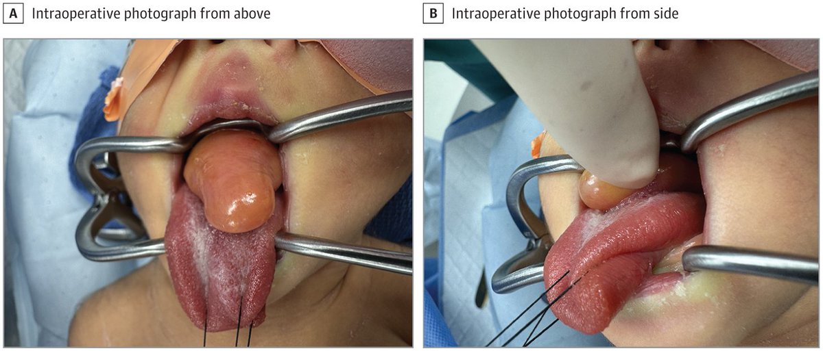 JAMA Otolaryngology – Head & Neck Surgery (@jamaoto) on Twitter photo Most viewed this week from <a href="/JAMAOto/">JAMA Otolaryngology – Head & Neck Surgery</a>:
A large oral mass was noted at time of delivery in a female neonate at gestational age of 39 weeks.
ja.ma/3HuHDSj Most viewed this week from <a href="/JAMAOto/">JAMA Otolaryngology – Head & Neck Surgery</a>:
A large oral mass was noted at time of delivery in a female neonate at gestational age of 39 weeks.
ja.ma/3HuHDSj