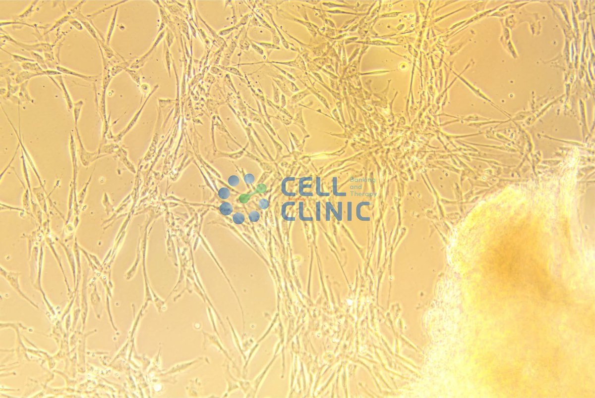 Энэ зурагт Селл Клиник-ийн лабораторид боловсруулсан хамгийн залуу (0 настай), хамгийн идэвхтэй хүйн мезенхимийн супер үүдэл эс харагдаж байна.

Ер нь хүй яагаад үнэлшгүй гэж?

Хүйнээс гаргаж авсан үүдэл эс бол
⚠️ Элэгний цочмог дутагдал,
🔥 Нойр булчирхайн үрэвсэл,
🦴 Үе мөчний