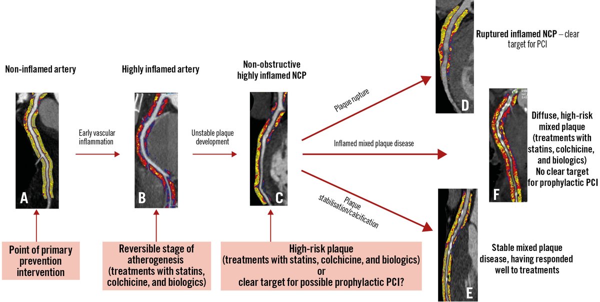 Pericoronary adipose tissue (PCAT) attenuation on CCTA is a novel marker linked to increased cardiac mortality and major events. This study shows that PCAT attenuation independently predicts adverse outcomes after PCI and improves risk stratification when added to standard CCTA