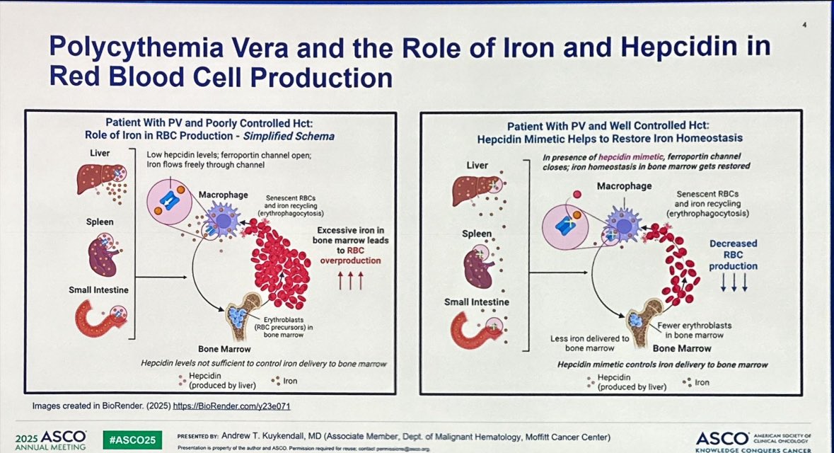 Amisha Gupta (@amishagupta2012) on Twitter photo Proud Mentee Moment! <a href="/KuykendallMd/">Andrew Kuykendall MD</a> presenting the practice-changing VERIFY Trial using #Rusfertide for #PolycythemiaVera during an exceptional Plenary Session at <a href="/ASCO/">ASCO</a> <a href="/MoffittNews/">Moffitt Cancer Center</a> <a href="/oncodaily/">OncoDaily</a> Proud Mentee Moment! <a href="/KuykendallMd/">Andrew Kuykendall MD</a> presenting the practice-changing VERIFY Trial using #Rusfertide for #PolycythemiaVera during an exceptional Plenary Session at <a href="/ASCO/">ASCO</a> <a href="/MoffittNews/">Moffitt Cancer Center</a> <a href="/oncodaily/">OncoDaily</a>