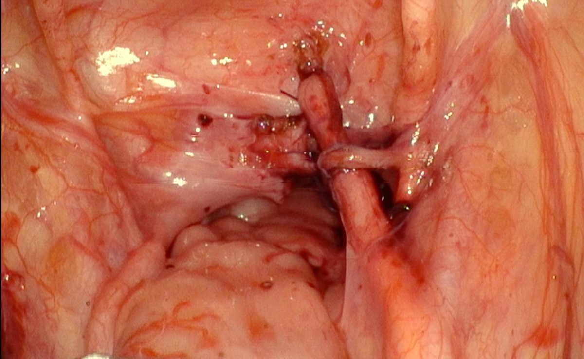 8 months baby (robotic SSI mantra ) detrusorrhaphy . We used 3 ports only. Link
youtu.be/XnRrUFMLwWk
Suggestions welcome