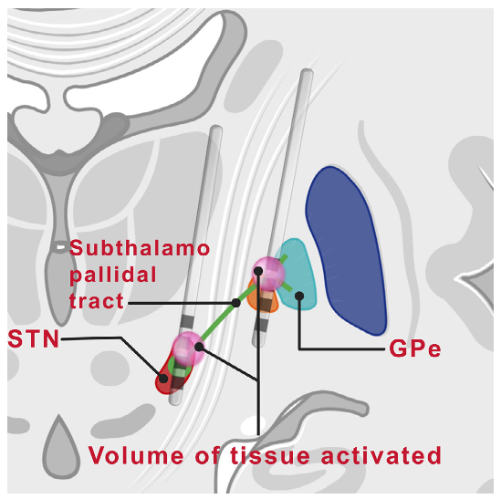 Takashi Morishita(森下 登史) (@tmorishita_md) on Twitter photo This is a very impressive work by the University of Florida team. Clinicians should know that even GPi DBS, which is supposed to suppress dyskinesia, may paradoxically induce dyskinesia. This paper shows the area that we should avoid stimulating.
…mentdisorders.onlinelibrary.wiley.com/doi/full/10.10… This is a very impressive work by the University of Florida team. Clinicians should know that even GPi DBS, which is supposed to suppress dyskinesia, may paradoxically induce dyskinesia. This paper shows the area that we should avoid stimulating.
…mentdisorders.onlinelibrary.wiley.com/doi/full/10.10…