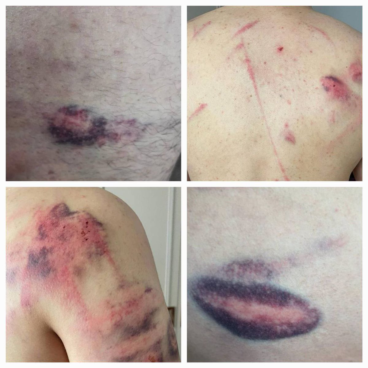 This is how Israeli occupation forces treated a Palestinian youth in Jericho, occupied West Bank, last night!