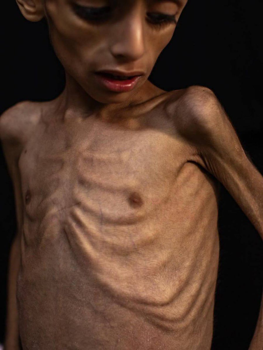 bundaathira's tweet image. Osama Al-Riqib, seorang anak berusia 5 tahun, menderita penurunan berat badan dan kelemahan tulang akibat kekurangan gizi yang disebabkan oleh penutupan perbatasan dan blokade masuknya makanan ke Gaza. 

#GazaStarving #GazaHunger #AidForGaza #OpenRafahSaveGaza